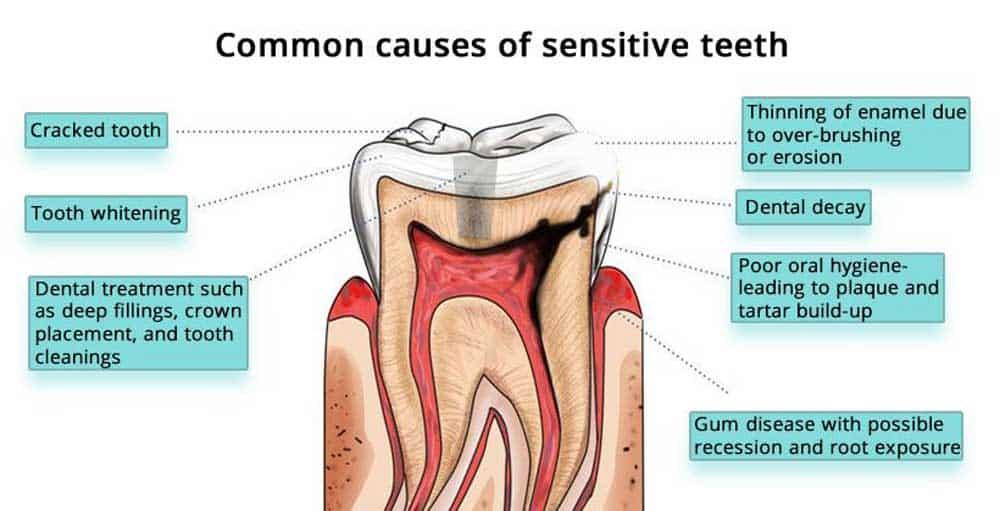 Teeth Sensitivity Causes