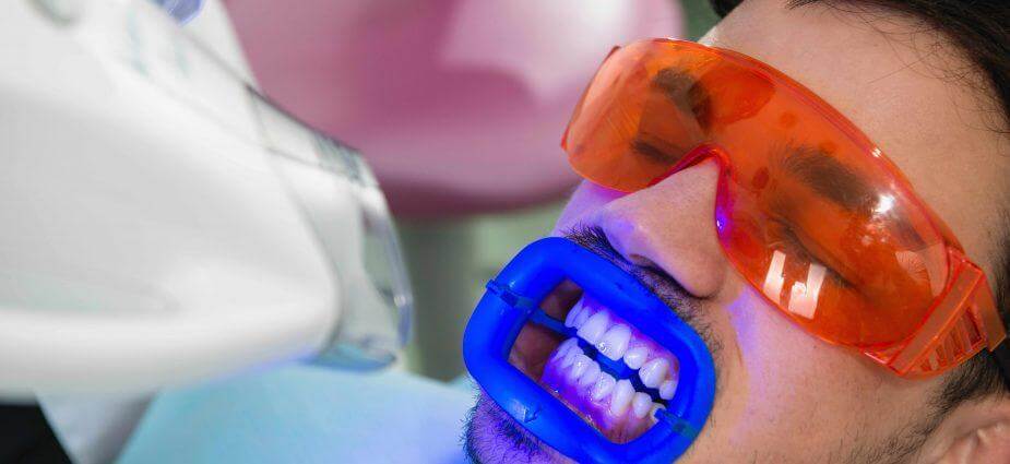 Professional Teeth Whitening Benefits
